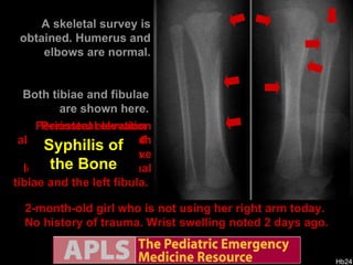 2-month-old girl who is not using her right arm today.  No history of trauma. Wrist swelling noted 2 days ago. Syphilis of the Bone Destructive lytic lesions of the distal radius and ulna.  Periosteal elevation of the radius and ulna. A skeletal survey is obtained. Humerus and elbows are normal. Femurs are shown here. Periosteal elevation along the length of both femurs. Both tibiae and fibulae are shown here. Periosteal elevation along the length of both tibiae. Destructive lesions of the proximal tibiae and the left fibula.  