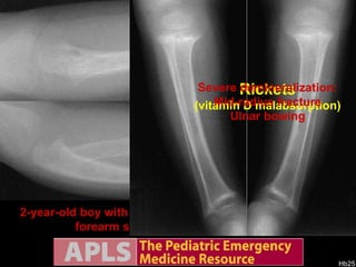 2-year-old boy with chronic liver disease with persistent forearm swelling 3 days after falling. Rickets (vitamin D malabsorption) Severe demineralization: Mid-radius fracture Ulnar bowing 