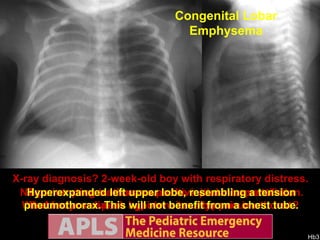 X-ray diagnosis? 2-week-old boy with respiratory distress. Tension pneumothorax was the initial interpretation. What features speak against a tension pneumothorax? No penetrating trauma, no positive pressure ventilation. No bradycardia, no hypotension. Hypoxia is modest. Congenital Lobar Emphysema Hyperexpanded left upper lobe, resembling a tension pneumothorax. This will not benefit from a chest tube. 