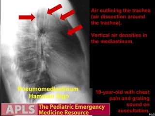 19-year-old with chest pain and grating   sound on auscultation. Pneumomediastinum  Hamman Sign Vertical air densities Air filled aorto-pulmonarywindow Air outlining the trachea (air dissection around the trachea).  Vertical air densities in the mediastinum. 