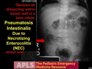 3 day old premie with hematemesis. Pneumatosis Intestinalis Due to Necrotizing Enterocolitis (NEC) Enlarged view:  White arrows point at air dissecting within the bowel wall. Double density (“railroad tracks”). Air dissecting in the bowel wall. Double outlining (railroad tracks). Bubbles in the bowel wall. Obvious air dissecting within bowel wall in a term infant. 