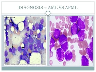 Acute Promyelocytic Leukemia (APML) .pptx