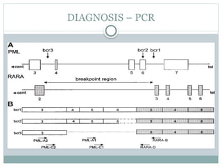 Acute Promyelocytic Leukemia (APML) .pptx