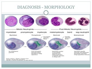 Acute Promyelocytic Leukemia (APML) .pptx