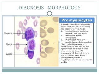 Acute Promyelocytic Leukemia (APML) .pptx