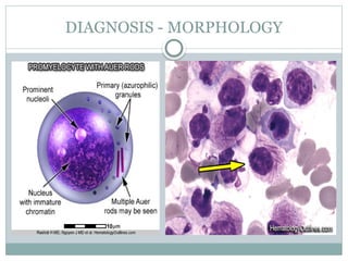Acute Promyelocytic Leukemia (APML) .pptx