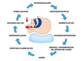 apnea-obstructiva-del-sue-o-fisiopatologia-pptx