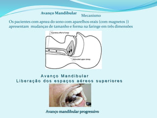Os pacientes com apnea do sono com aparelhos orais (com magnetos ))
apresentam mudanças de tamanho e forma na faringe em três dimensões
Avanço Mandibular
Mecanismo
A v a n ç o M a n d i b u l a r
L i b e r a ç ã o d o s e s p a ç o s a é r e o s s u p e r i o r e s
Avanço mandibular progressivo
 