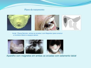 Plano de tratamento
Inicial : Placas flexíveis ambas as arcadas ) com Magnetos )para construir
a mordida e liberar e espaços aéreos
Aparelho com magnetos em ambas as arcadas com selamento labial
 