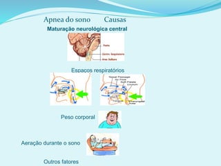 Outros fatores
Apnea do sono Causas
Espaços respiratórios
Aeração durante o sono
Peso corporal
Maturação neurológica central
 