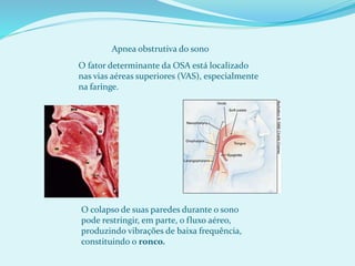 O fator determinante da OSA está localizado
nas vias aéreas superiores (VAS), especialmente
na faringe.
Apnea obstrutiva do sono
O colapso de suas paredes durante o sono
pode restringir, em parte, o fluxo aéreo,
produzindo vibrações de baixa frequência,
constituindo o ronco.
 
