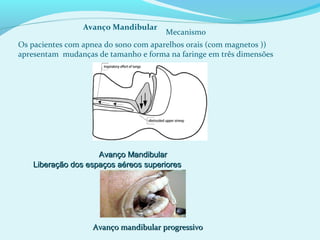 Os pacientes com apnea do sono com aparelhos orais (com magnetos ))
apresentam mudanças de tamanho e forma na faringe em três dimensões
Avanço Mandibular
Mecanismo
Avanço MandibularAvanço Mandibular
Liberação dos espaços aéreos superioresLiberação dos espaços aéreos superiores
Avanço mandibular progressivoAvanço mandibular progressivo
 