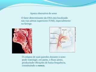 O fator determinante da OSA está localizado
nas vias aéreas superiores (VAS), especialmente
na faringe.
Apnea obstrutiva do sono
O colapso de suas paredes durante o sono
pode restringir, em parte, o fluxo aéreo,
produzindo vibrações de baixa frequência,
constituindo o ronco.
 