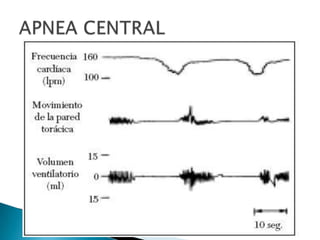 A P N E A  N E O N A T A L