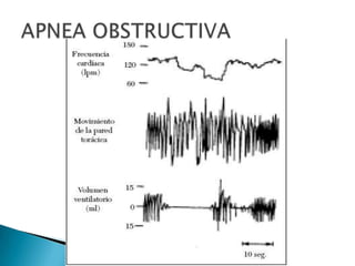 A P N E A  N E O N A T A L