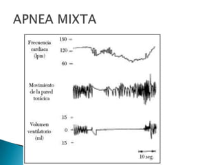 A P N E A  N E O N A T A L