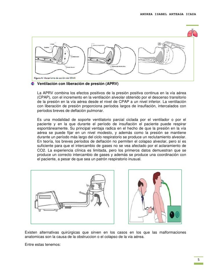 Apnea obstructiva del sueño