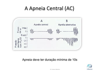 Apneia deve ter duração mínima de 10s
3
A Apneia Central (AC)
 