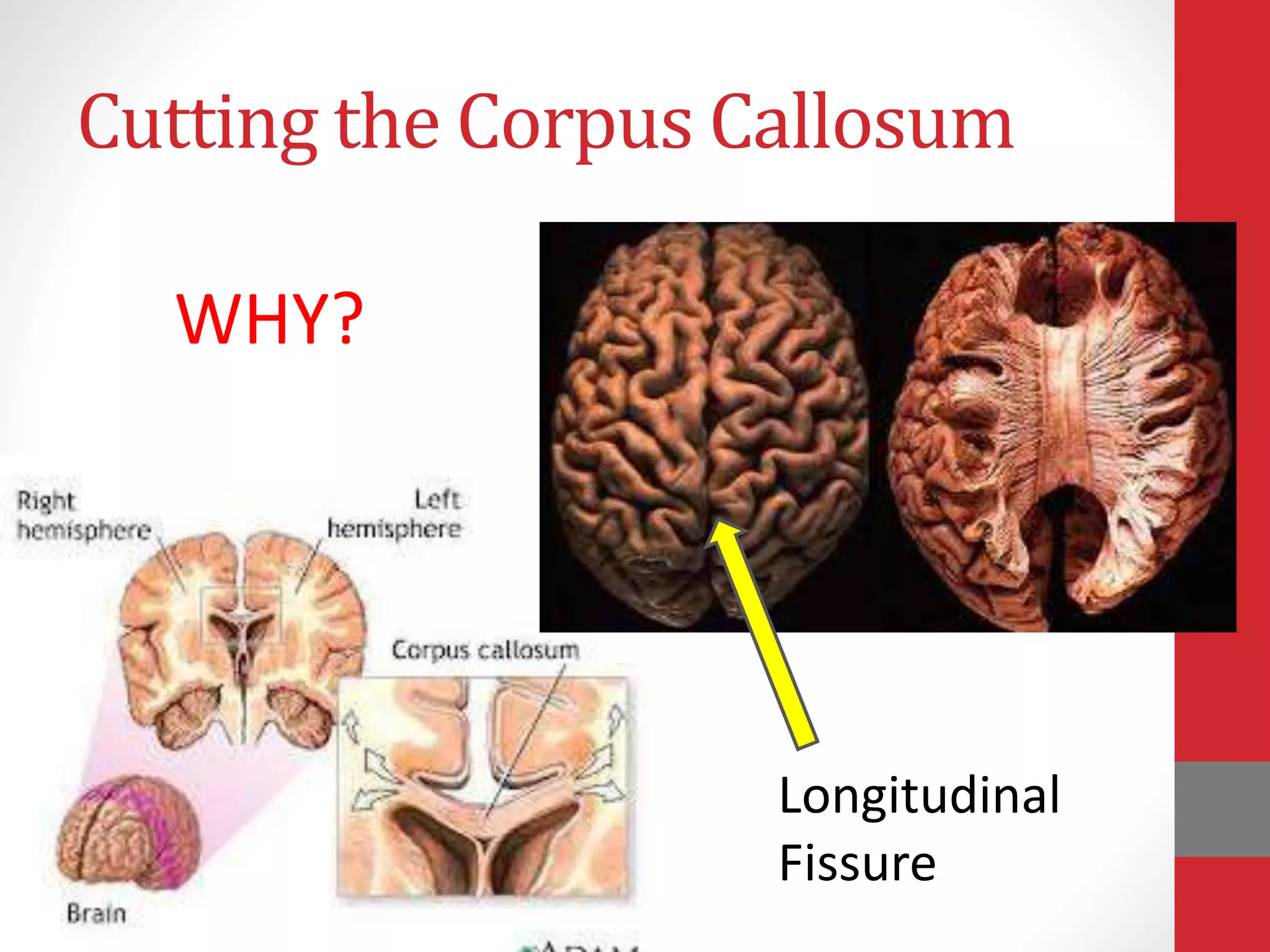 Cutting the Corpus Callosum
WHY?
Longitudinal
Fissure
 