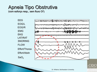 Apneia Tipo Obstrutiva
(com esforço resp., sem fluxo O2)


        EEG
        EOG/L
        EOG/R
        EMG
        EKG
        LAT/RAT
        SNORING
        FLOW
        Effort/Thorax
        Effort/Abdn
        SaO2



                                    Dr. Williams, Northwestern University.
 