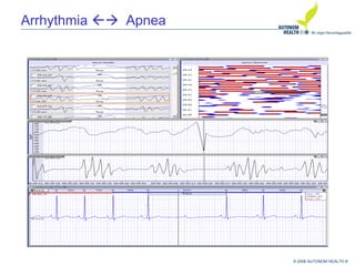 © 2008 AUTONOM HEALTH ®
Arrhythmia Apnea
 