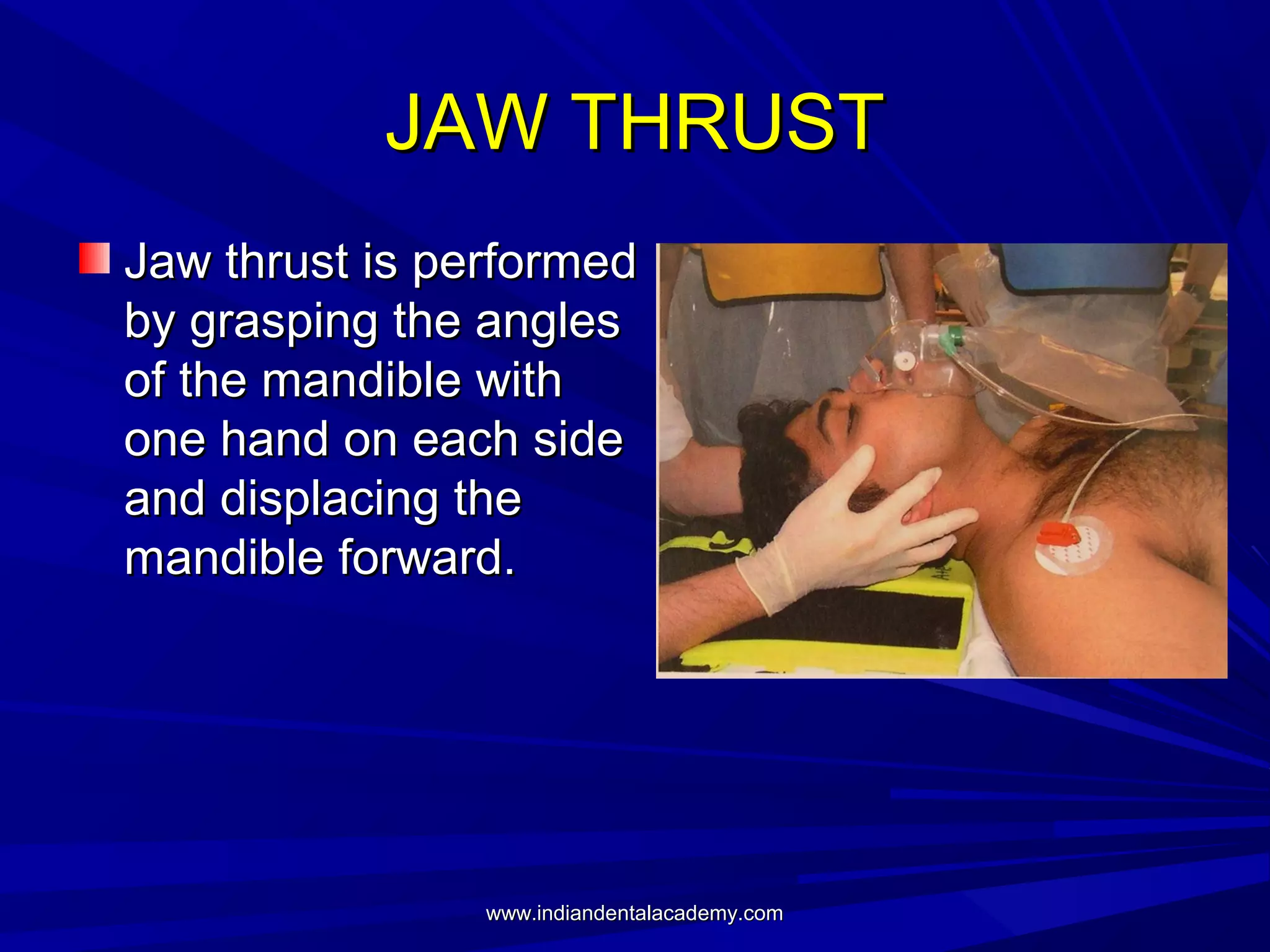 JAW THRUST
Jaw thrust is performed
by grasping the angles
of the mandible with
one hand on each side
and displacing the
mandible forward.

www.indiandentalacademy.com

 