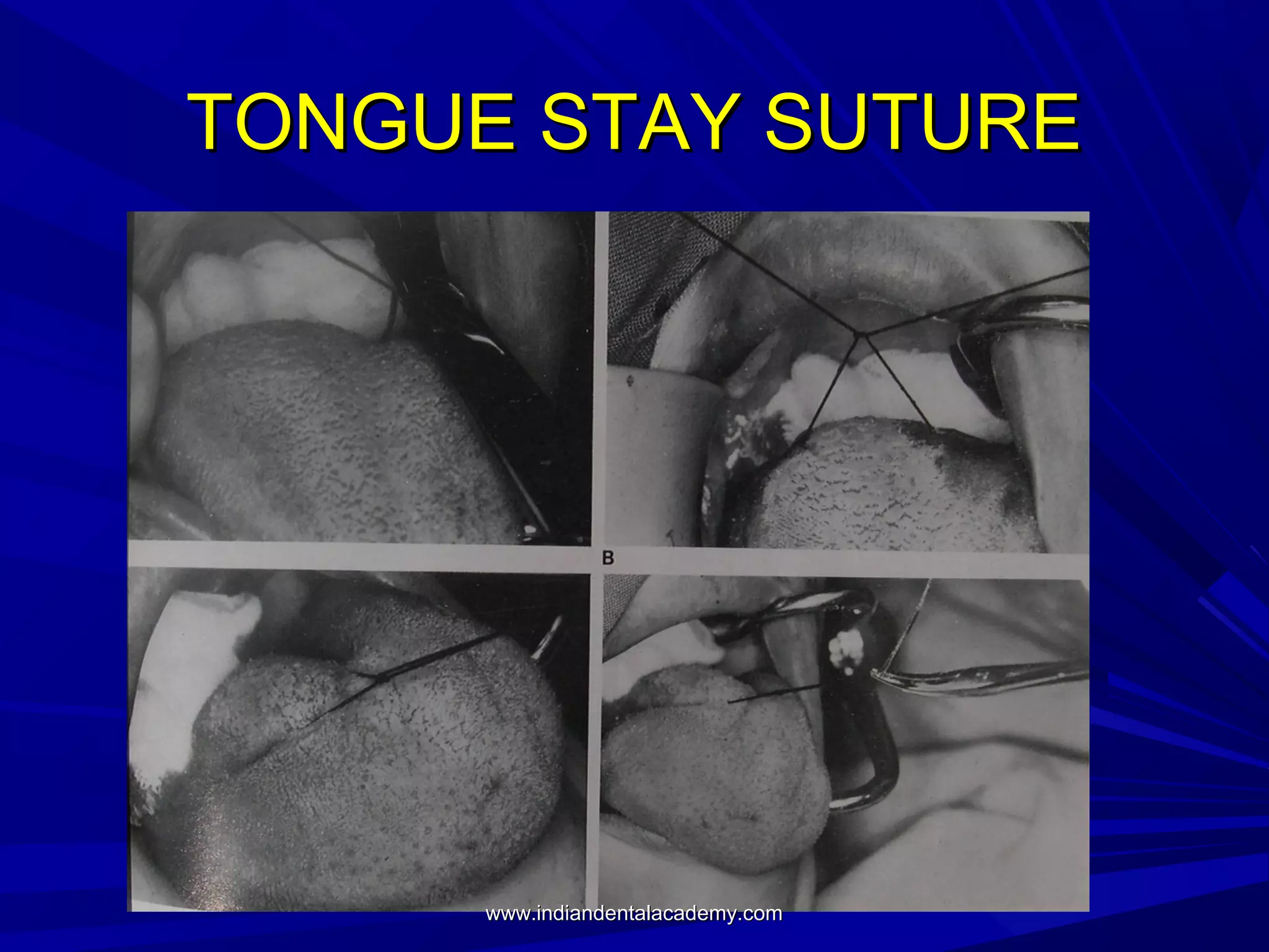 TONGUE STAY SUTURE

www.indiandentalacademy.com

 