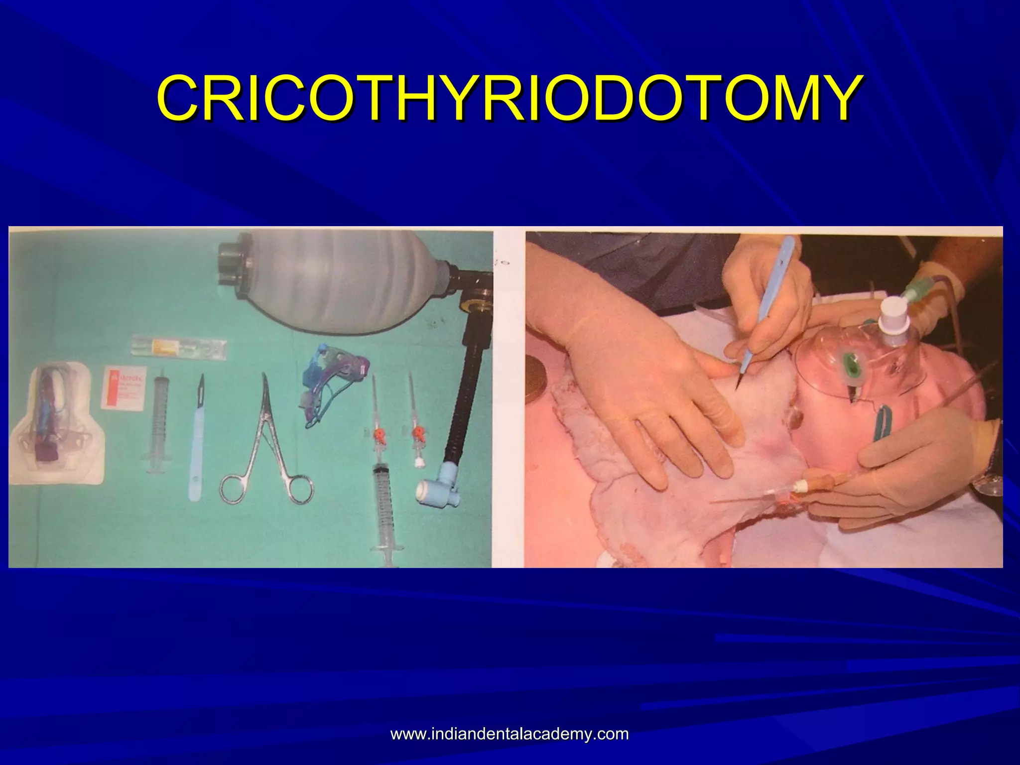 CRICOTHYRIODOTOMY

www.indiandentalacademy.com

 