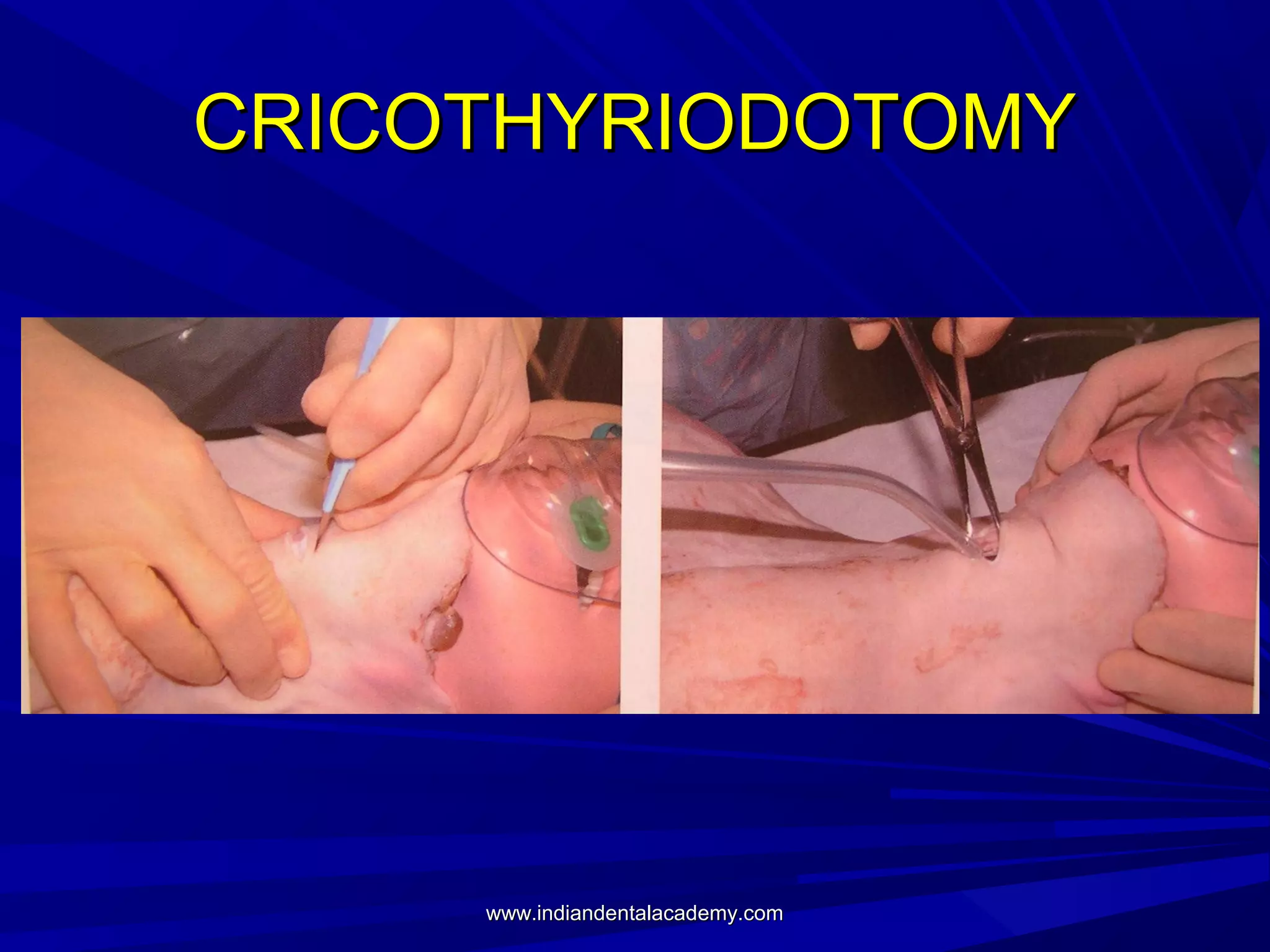 CRICOTHYRIODOTOMY

www.indiandentalacademy.com

 