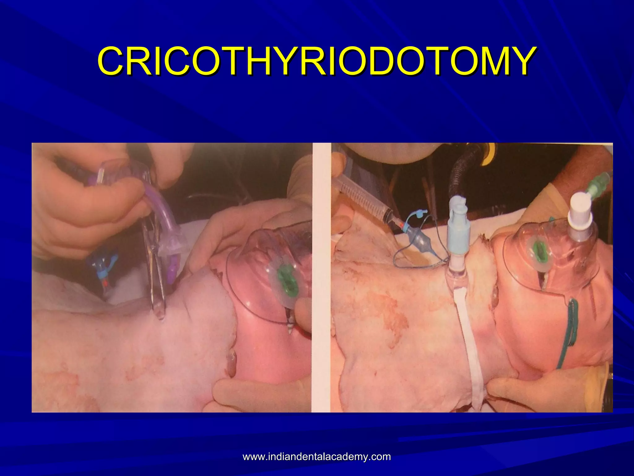 CRICOTHYRIODOTOMY

www.indiandentalacademy.com

 