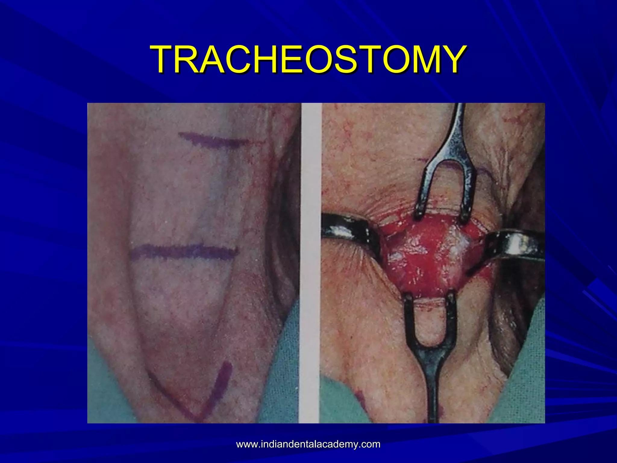 TRACHEOSTOMY

www.indiandentalacademy.com

 