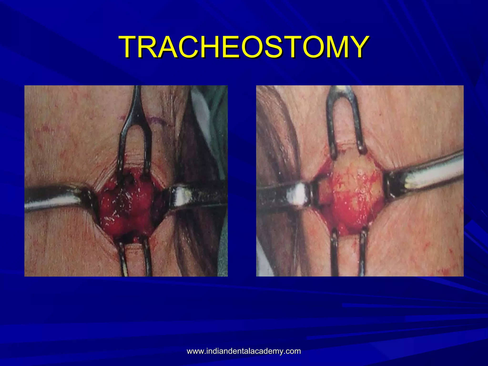 TRACHEOSTOMY

www.indiandentalacademy.com

 