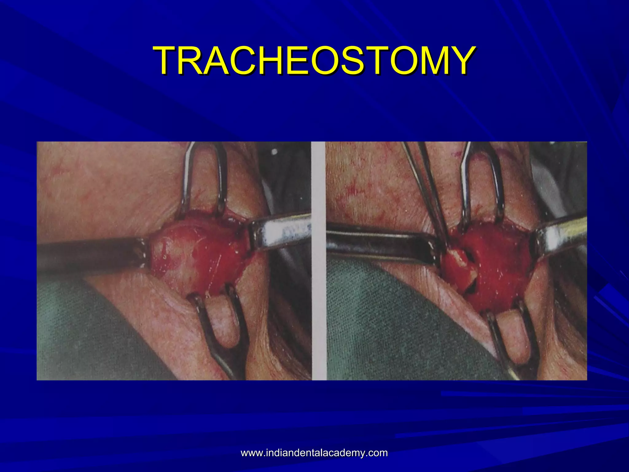 TRACHEOSTOMY

www.indiandentalacademy.com

 