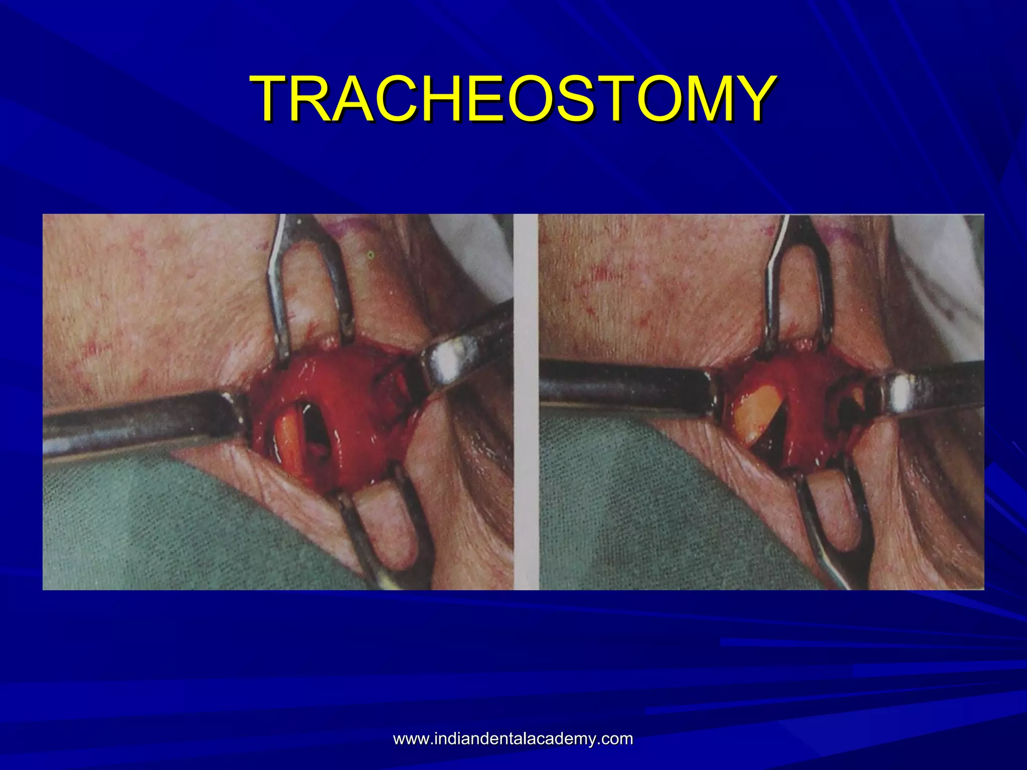 TRACHEOSTOMY

www.indiandentalacademy.com

 