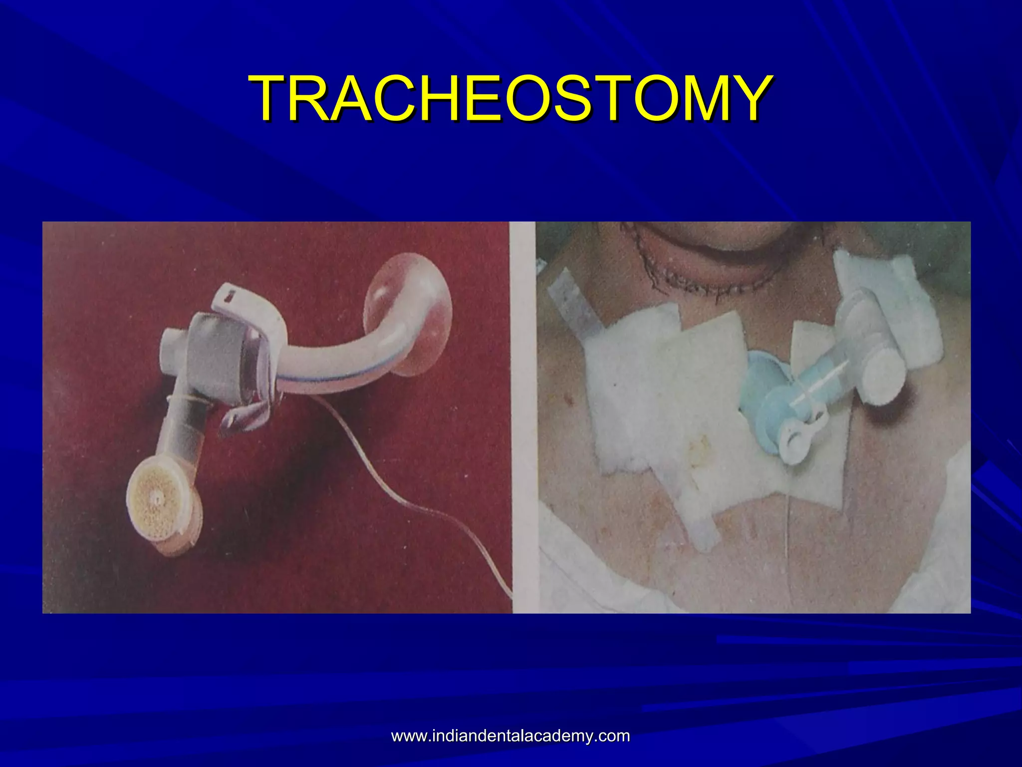 TRACHEOSTOMY

www.indiandentalacademy.com

 