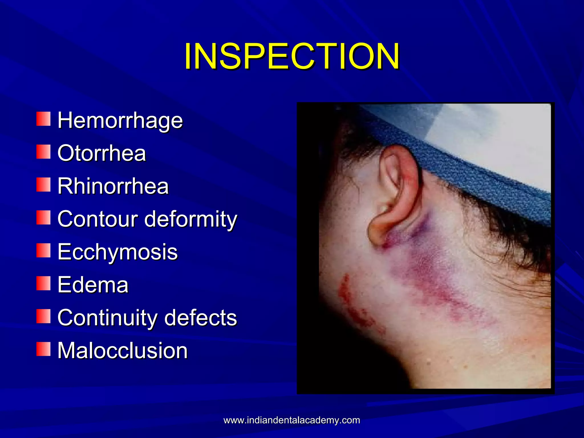 INSPECTION
Hemorrhage
Otorrhea
Rhinorrhea
Contour deformity
Ecchymosis
Edema
Continuity defects
Malocclusion
www.indiandentalacademy.com

 