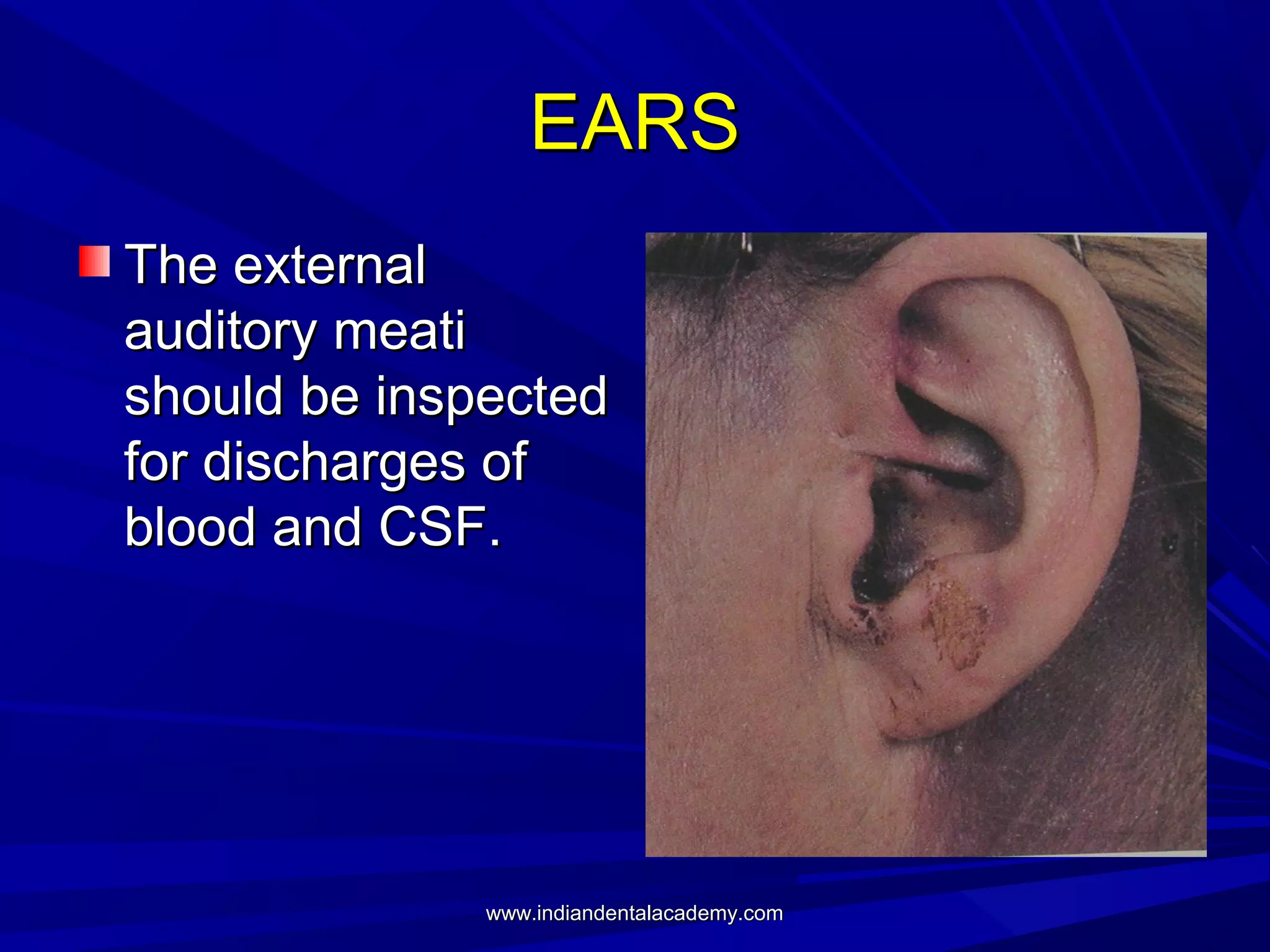 EARS
The external
auditory meati
should be inspected
for discharges of
blood and CSF.

www.indiandentalacademy.com

 