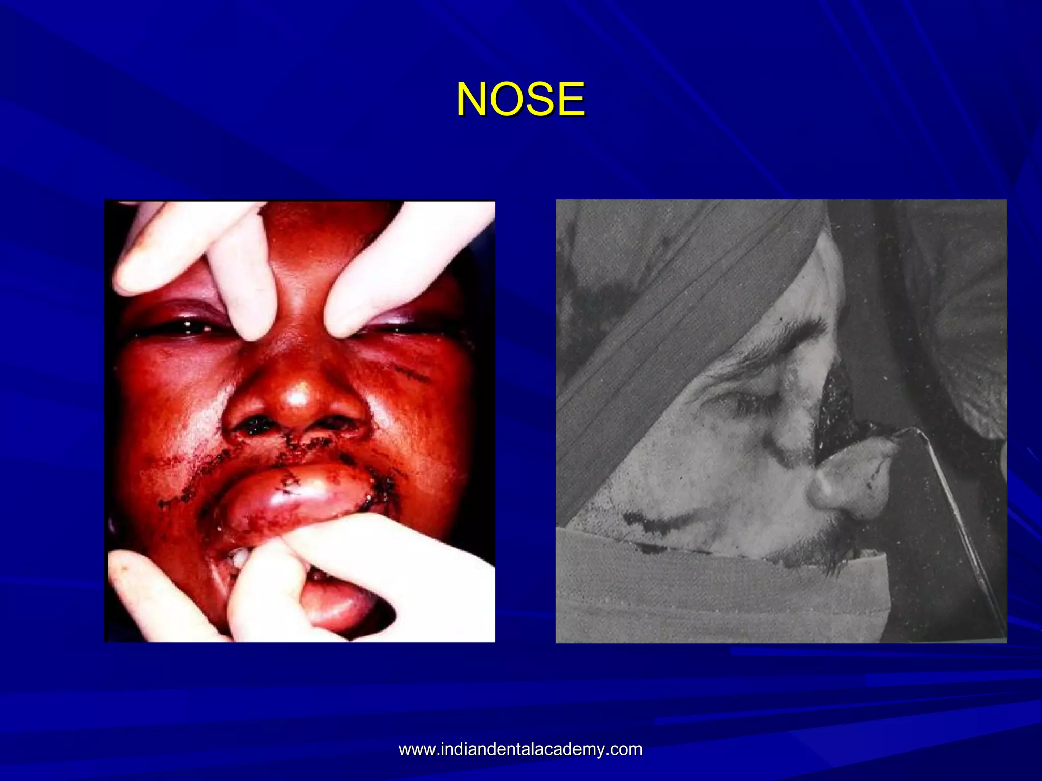 NOSE

www.indiandentalacademy.com

 
