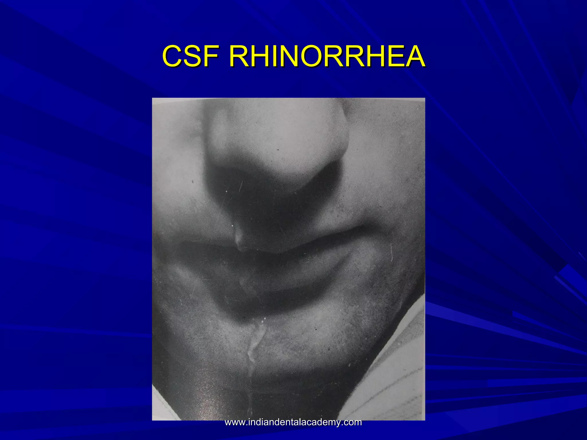 CSF RHINORRHEA

www.indiandentalacademy.com

 