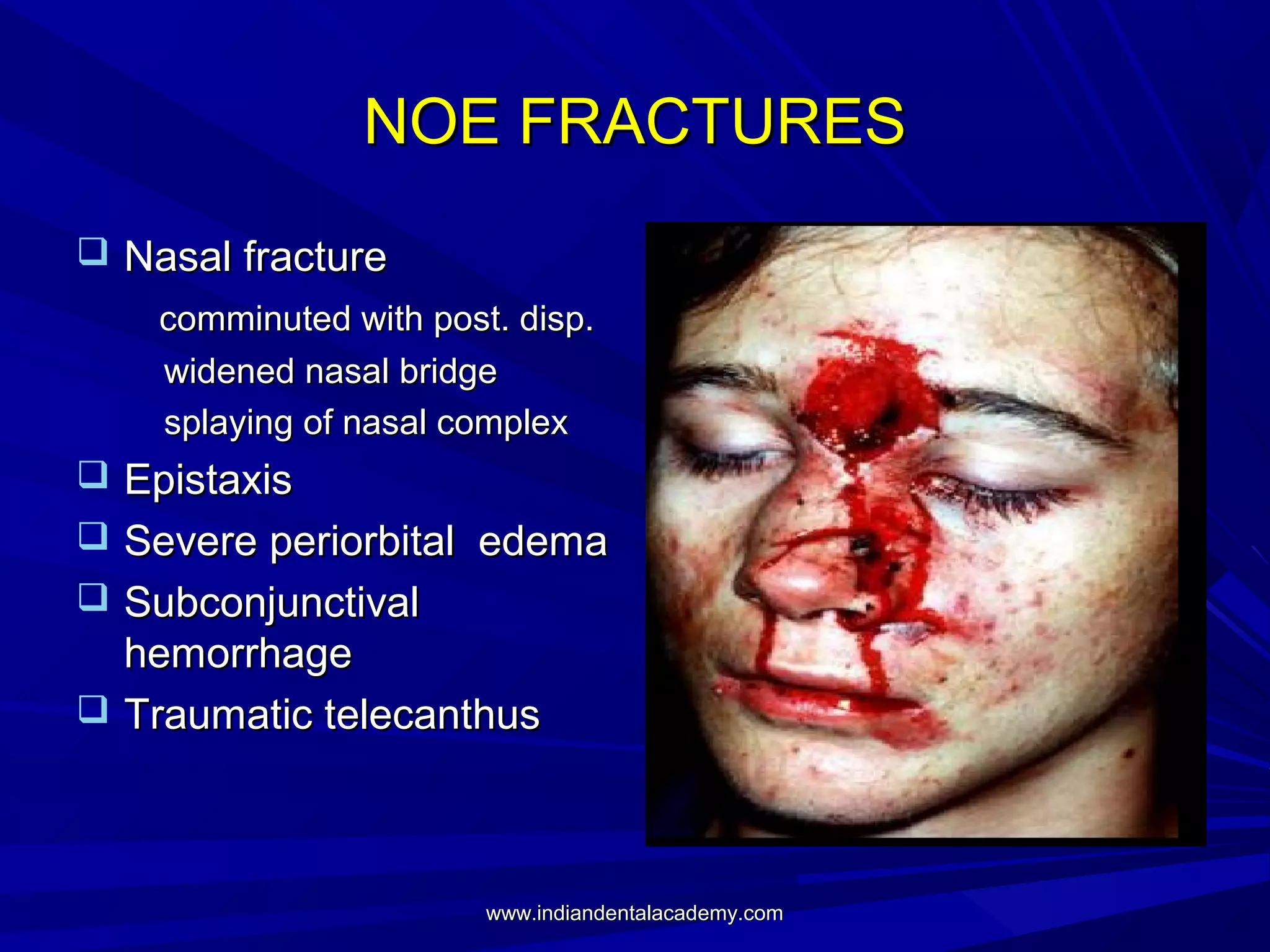 NOE FRACTURES
 Nasal fracture
comminuted with post. disp.
widened nasal bridge
splaying of nasal complex

 Epistaxis
 Severe periorbital edema
 Subconjunctival

hemorrhage
 Traumatic telecanthus

www.indiandentalacademy.com

 