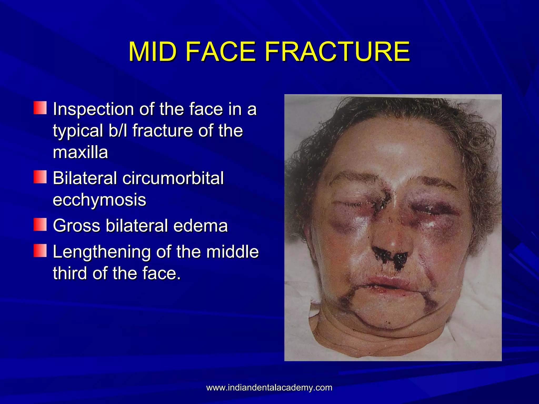 MID FACE FRACTURE
Inspection of the face in a
typical b/l fracture of the
maxilla
Bilateral circumorbital
ecchymosis
Gross bilateral edema
Lengthening of the middle
third of the face.

www.indiandentalacademy.com

 