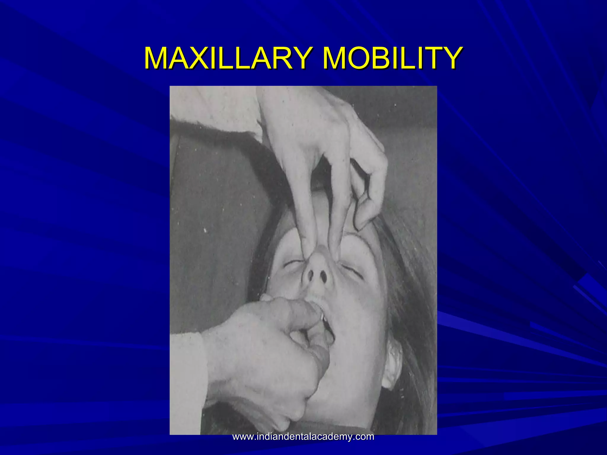 MAXILLARY MOBILITY

www.indiandentalacademy.com

 