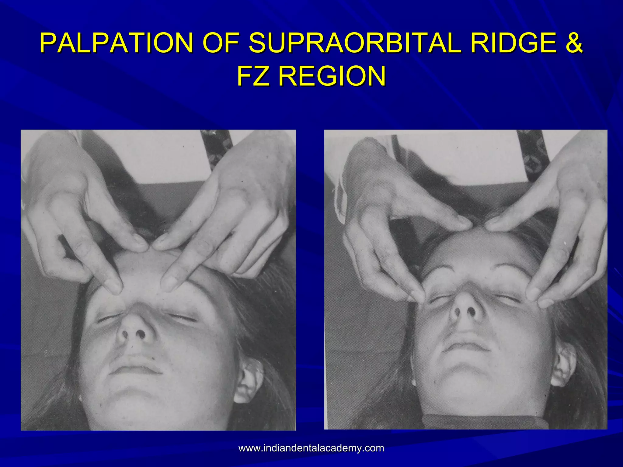 PALPATION OF SUPRAORBITAL RIDGE &
FZ REGION

www.indiandentalacademy.com

 