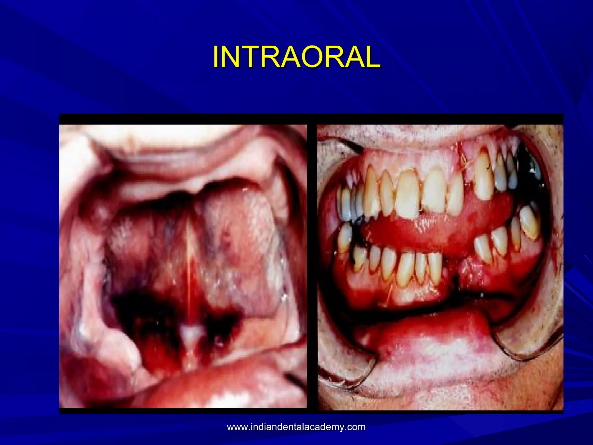 INTRAORAL

www.indiandentalacademy.com

 