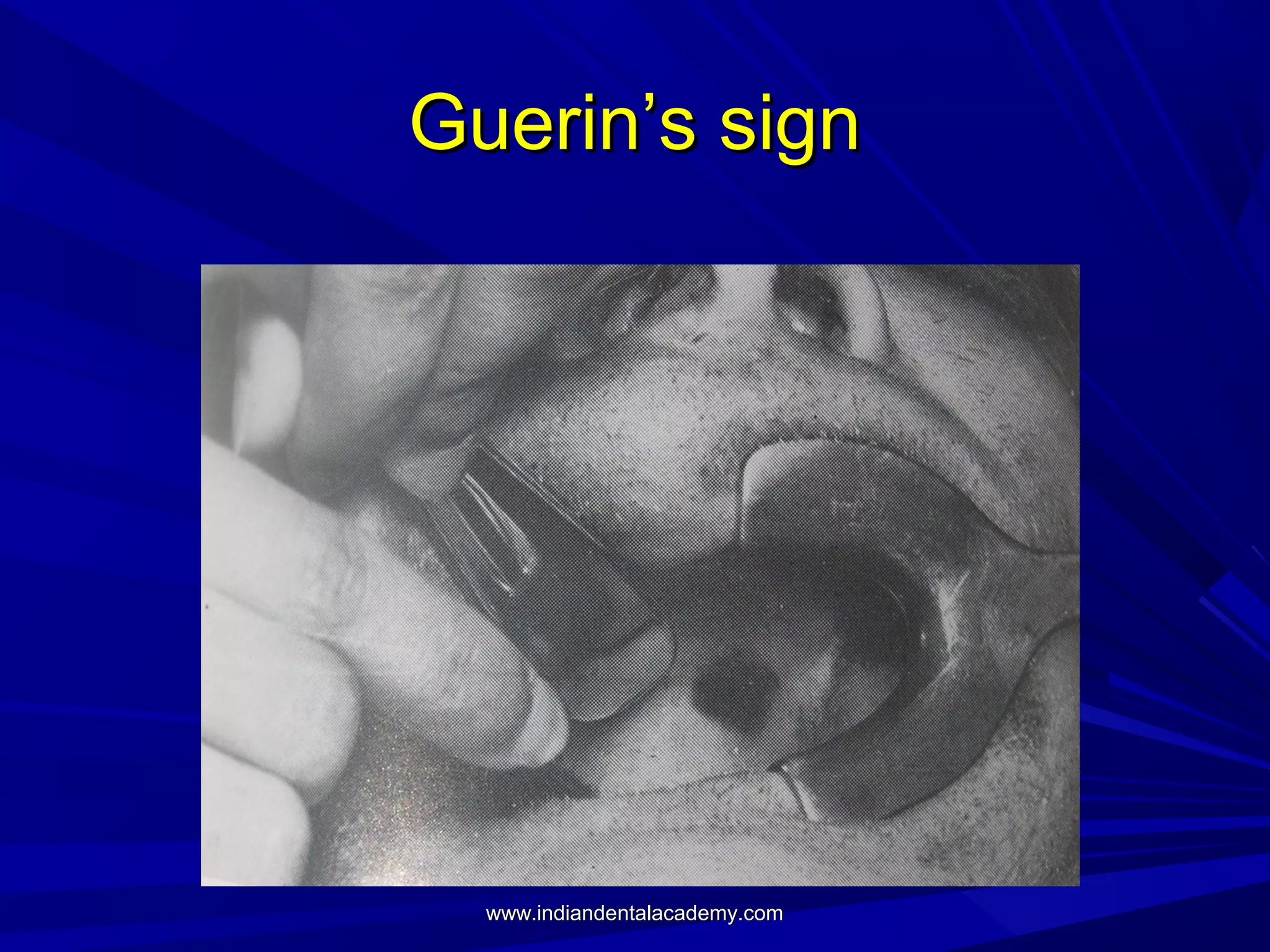 Guerin’s sign

www.indiandentalacademy.com

 