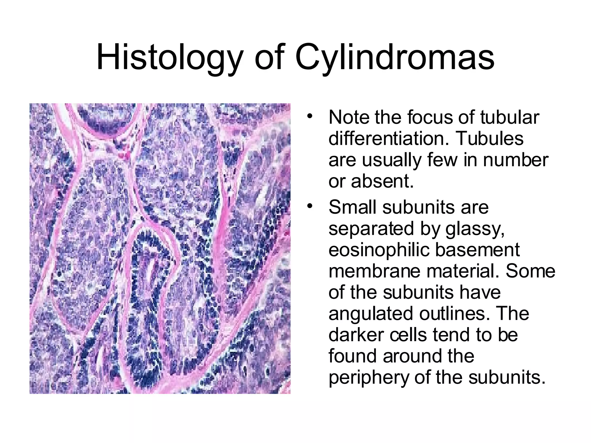 Histology of Cylindromas Note the focus of tubular differentiation. Tubules are usually few in number or absent. Small subunits are separated by glassy, eosinophilic basement membrane material. Some of the subunits have angulated outlines. The darker cells tend to be found around the periphery of the subunits.  