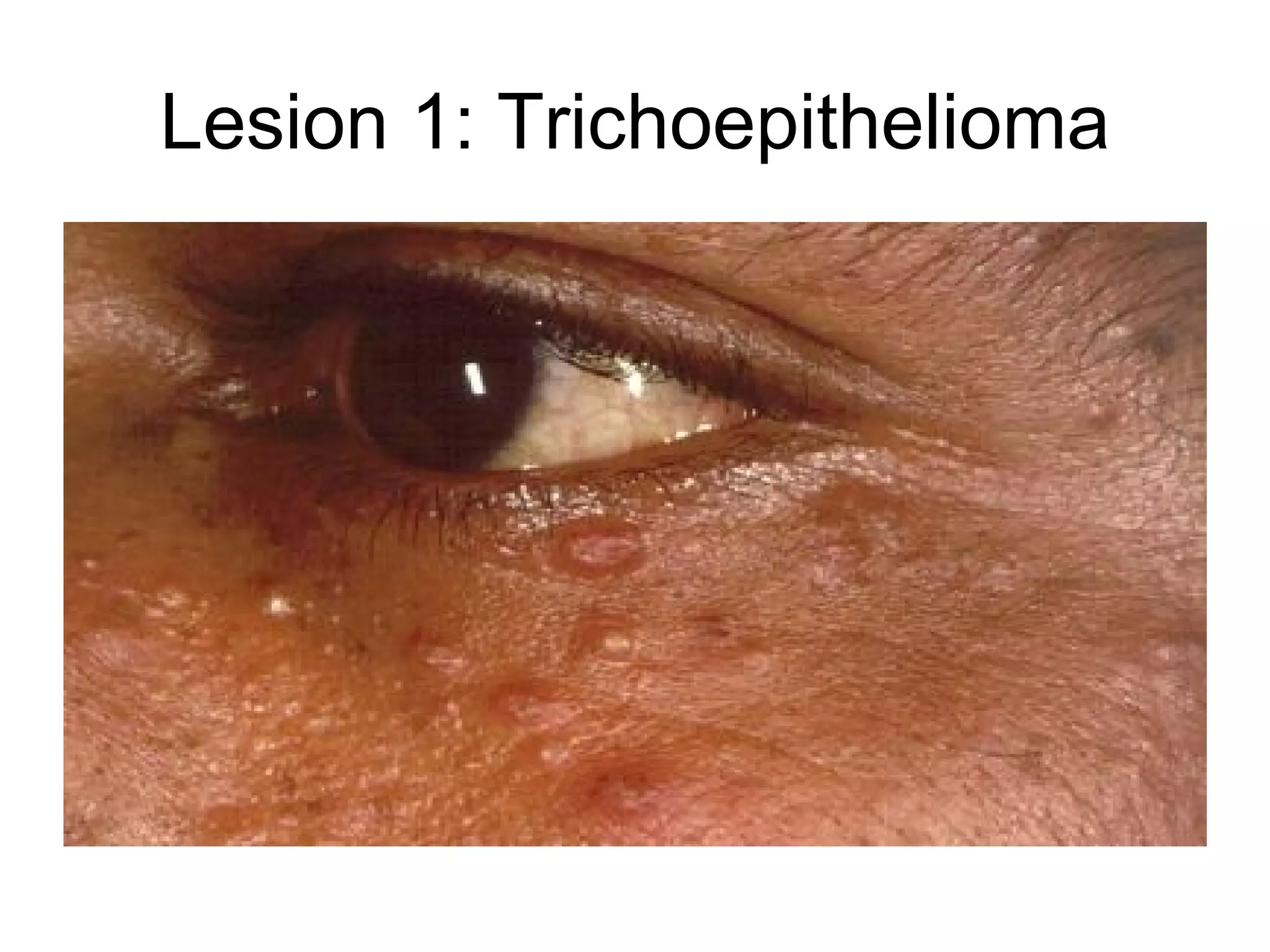 Lesion 1: Trichoepithelioma 