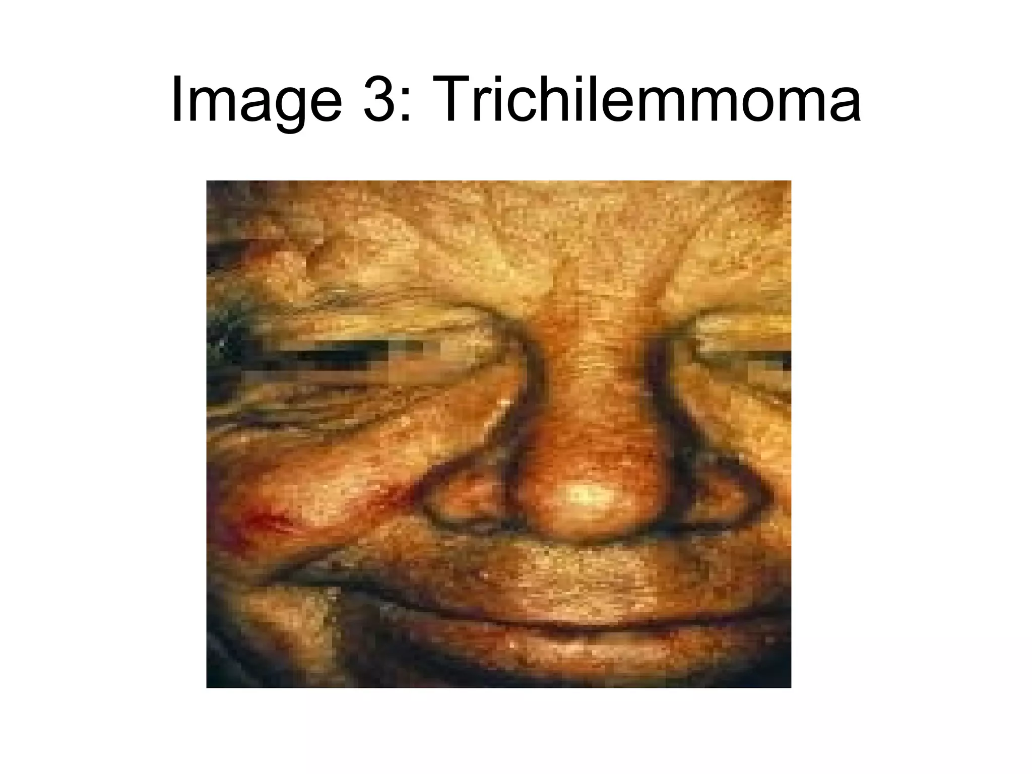 Image 3: Trichilemmoma 