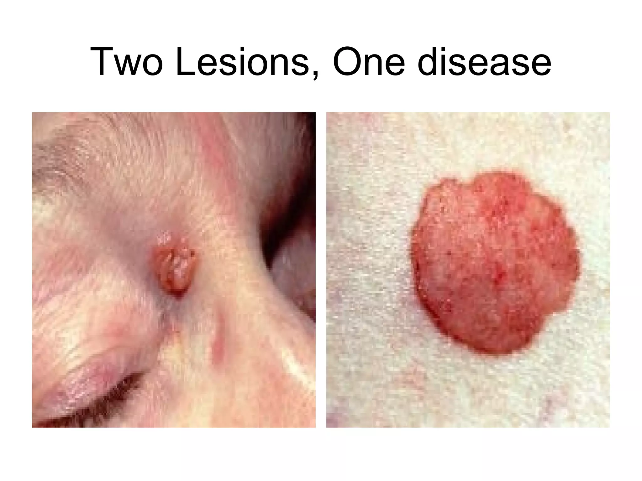 Two Lesions, One disease 