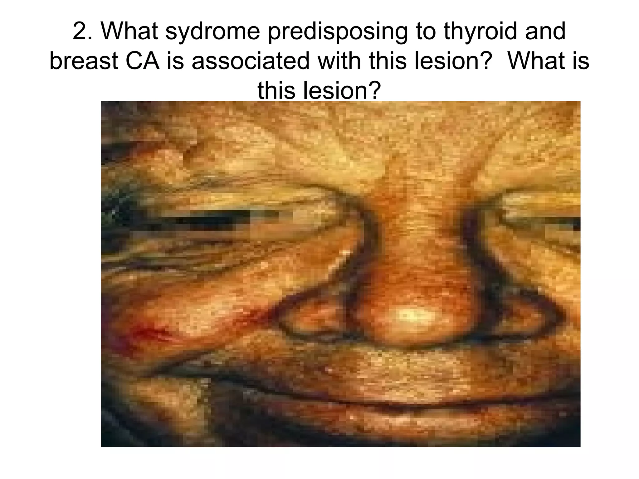 2. What sydrome predisposing to thyroid and breast CA is associated with this lesion?  What is this lesion? 